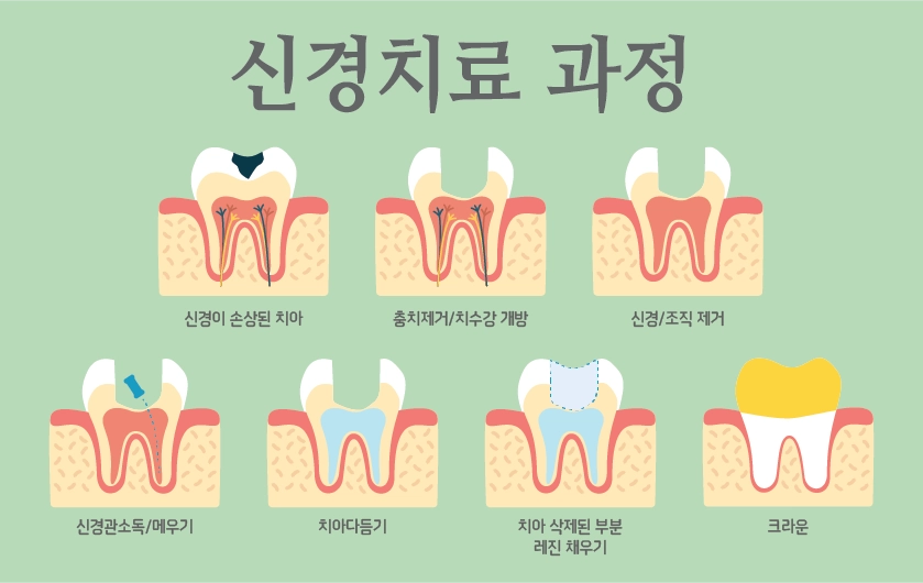 인터넷에서는 아프다고 하는데 실제로는 그렇게 아프지 않음